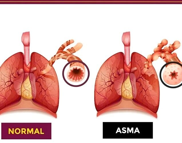 Causa, sintomas e tratamento da Asma – uma doença inflamatória crônica